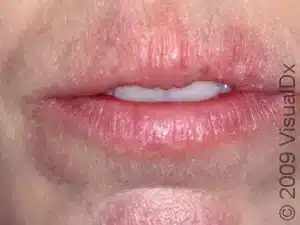 remedy for cracked lips, dry chapped lips,