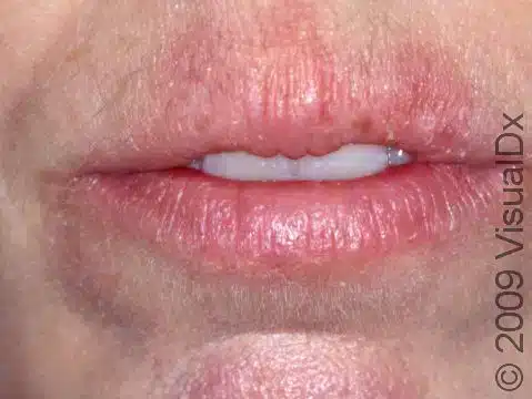remedy for cracked lips, dry chapped lips,