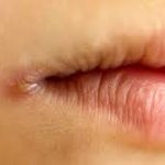 cracked corners of the mouth,