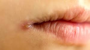 cracked corners of the mouth,