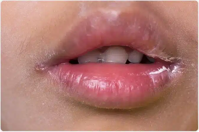 cracked corners of the mouth,