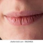 cracked lips,