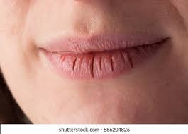 cracked lips,