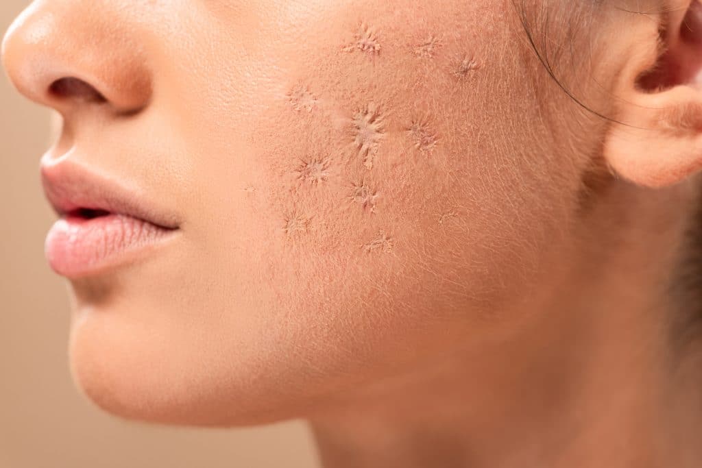 How to Treat Scars on the Face,facial scars,