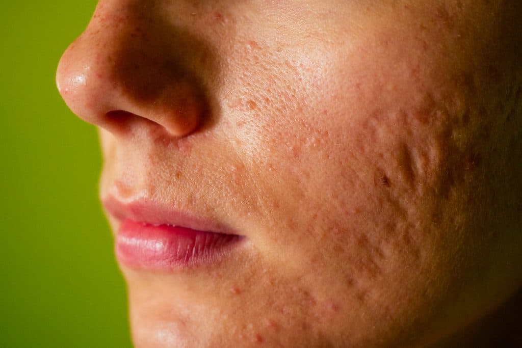 facial scars,