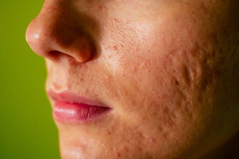 facial scars,