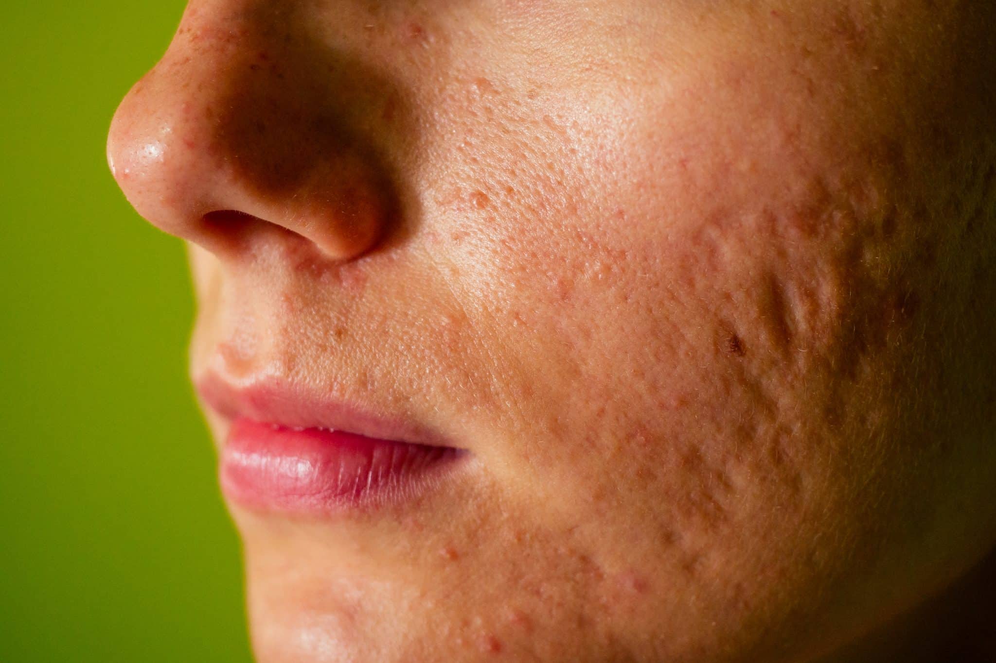 facial scars,