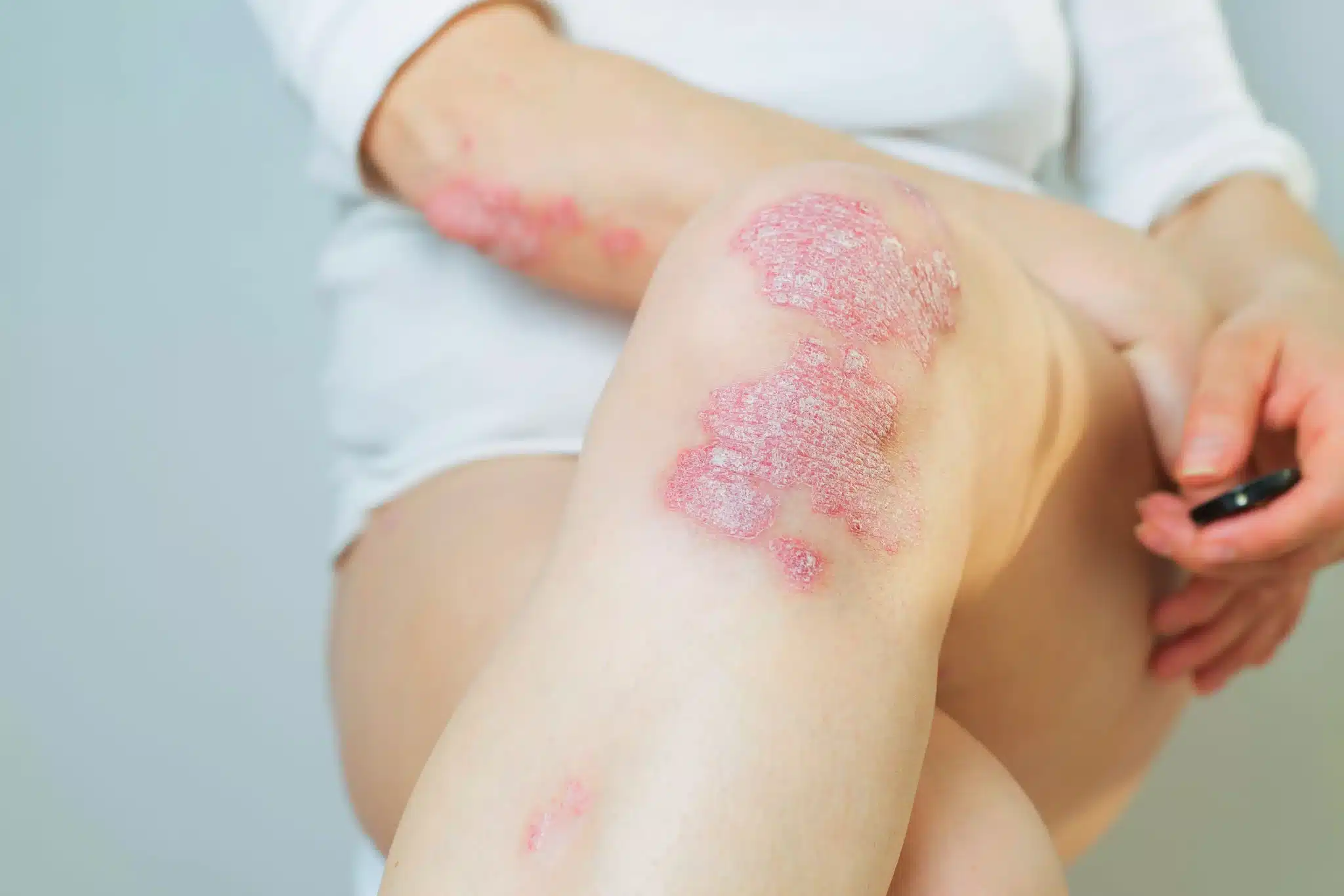 psoriasis cream, psoriatic arthritis cream,