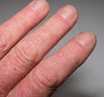 Psoriatic Arthritis Relief,