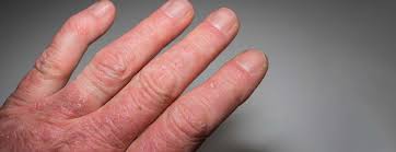 Psoriatic Arthritis Relief,