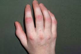 Psoriatic Arthritis relief,