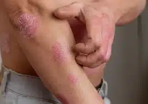 Psoriasis Cream vs. Natural Remedies: What Works Better?, Psoriatic Arthritis
