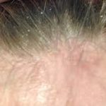 Seborrheic Dermatitis Shampoos, understanding seborrheic dermatitis, Sensitive Scalp Shampoos that Tackle Seborrheic Dermatitis, Seborrheic Eczema Treatment for Adults, Best Scalp Treatment for Seborrheic Dermatitis:, Best Scalp Treatment for Seborrheic Dermatitis:, seborrheic eczema treatment, Natural Shampoos for Sensitive Scalps, Best Shampoo for Sensitive Scalps, seborrheic dermatitis shampoo,