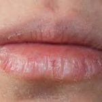 severely chapped lips,