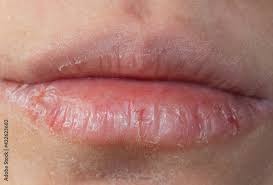 severely chapped lips,