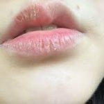 severely dried lips,