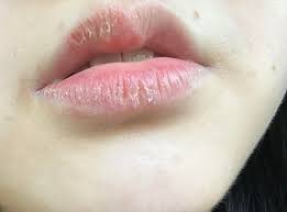 severely dried lips,