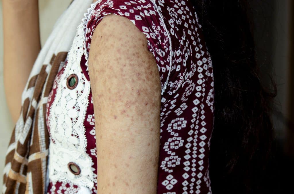 Cream for Sun-Damaged Skin,