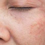 Seborrheic Dermatitis on the Face, sun damaged skin,