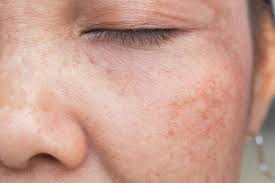 Seborrheic Dermatitis on the Face, sun damaged skin,