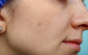 best cream for sun damaged skin, sun damage on face, snail cream foe sun damaged skin,