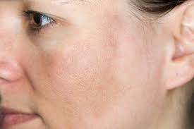 beast cream for sun damaged dkin,sun damage on face, sun damaged skin cream, snail cream for sun damaged skin,