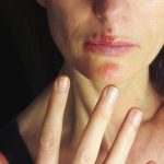 perioral dermatitis cream