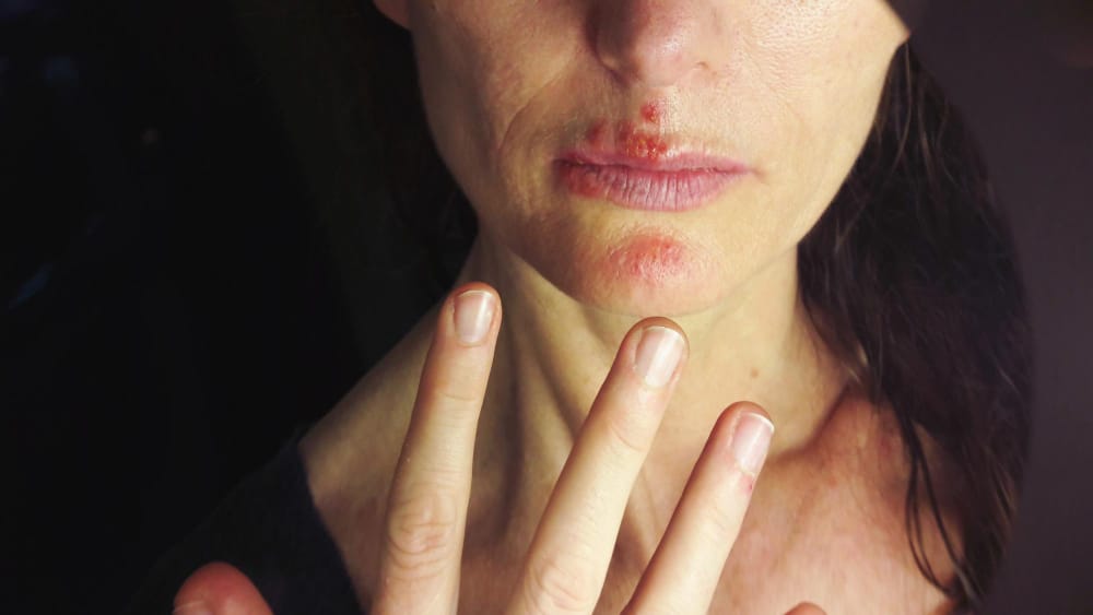 perioral dermatitis cream