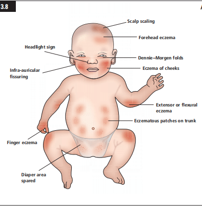 ​eczema treatment, natural eczema remedies, best creams for eczema, eczema treatment options, eczema relief products, Eczema in Small Babies, dermatitis in infants, Signs of Eczema in Infants