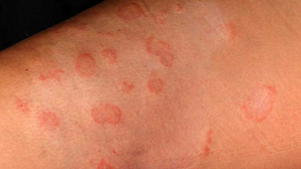 ringworm rash,