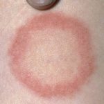 ringworm rash,