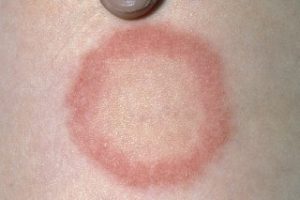 ringworm rash,
