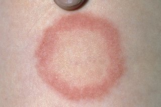 ringworm rash,