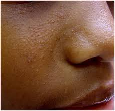 Seborrheic Dermatitis dark skin