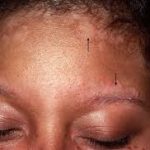 Sebaceous Dermatitis Shampoo, How Seborrheic Dermatitis Affects Dark skin, seborrheic dermatitis face cream, Seborrheic Dermatitis dark skin