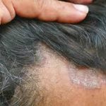 Seborrheic Dermatitis in Dark Skin
