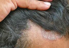 Seborrheic Dermatitis in Dark Skin