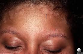 Sebaceous Dermatitis Shampoo, How Seborrheic Dermatitis Affects Dark skin, seborrheic dermatitis face cream, Seborrheic Dermatitis dark skin