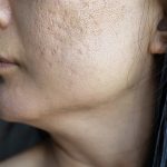 How to Treat Scars on the Face