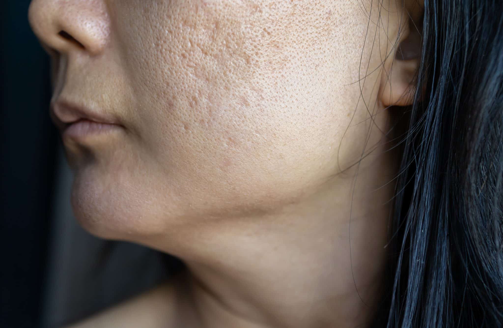 How to Treat Scars on the Face