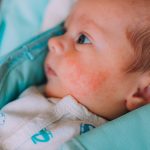 Atopic Eczema Treatment Creams for Babies, Eczema in Small Babies, Infant perioral dermatitis,