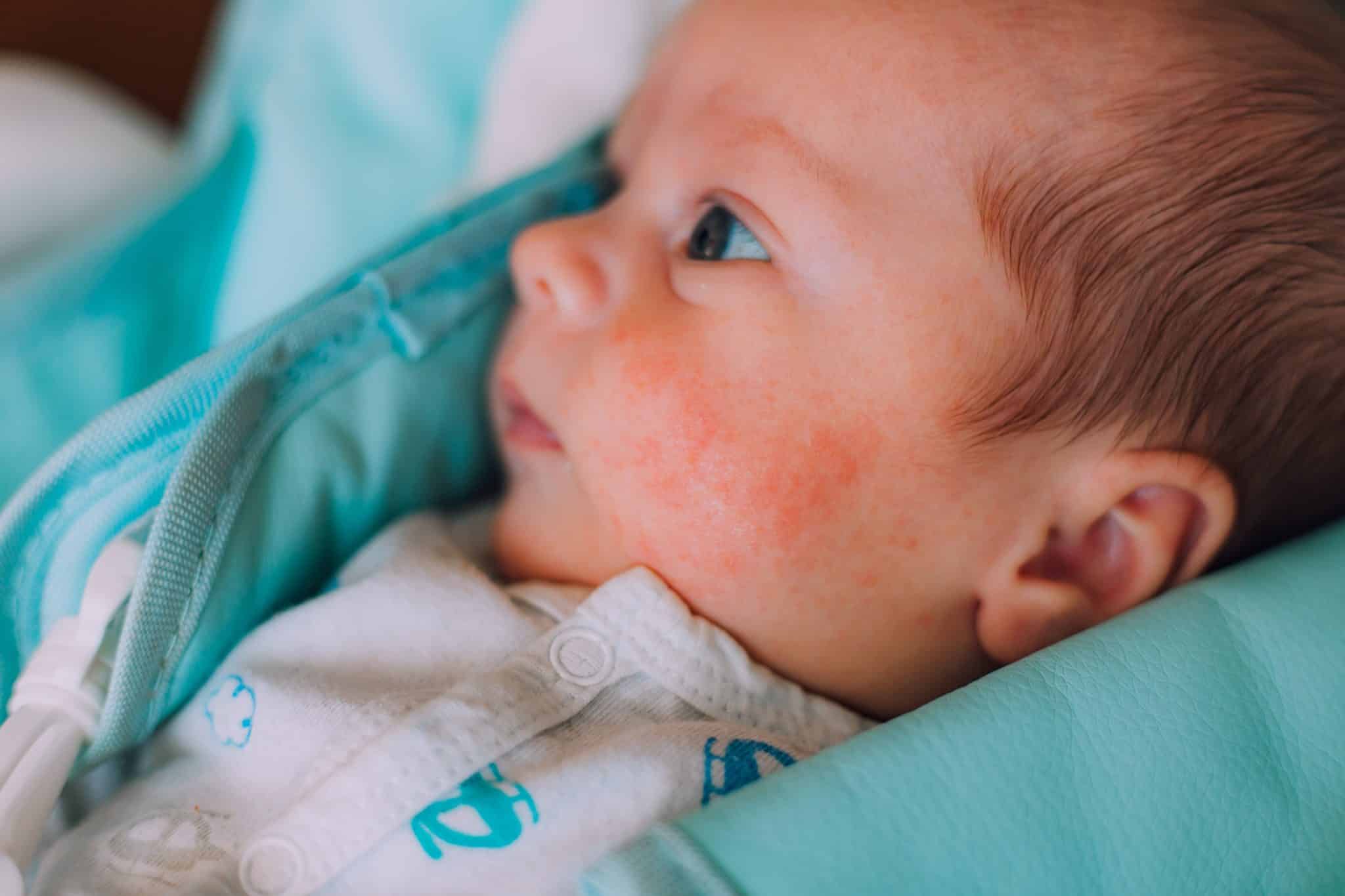 Atopic Eczema Treatment Creams for Babies, Eczema in Small Babies, Infant perioral dermatitis,