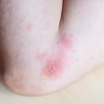 Best Cream for Contact Dermatitis