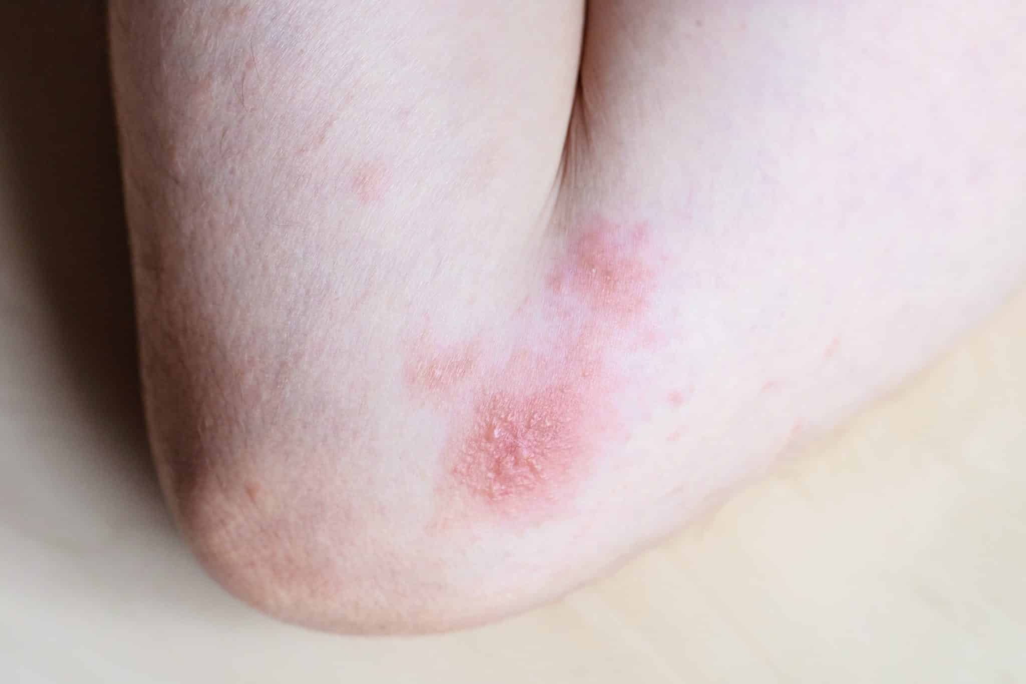 Best Cream for Contact Dermatitis
