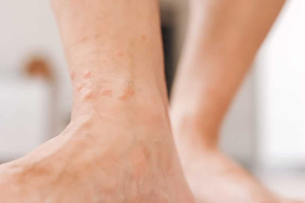 allergic reaction rash,