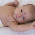 infant eczema treatment,