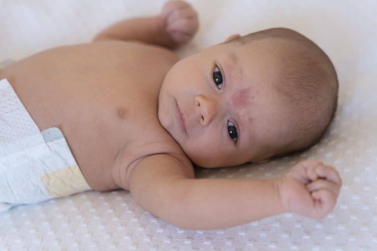 infant eczema treatment,