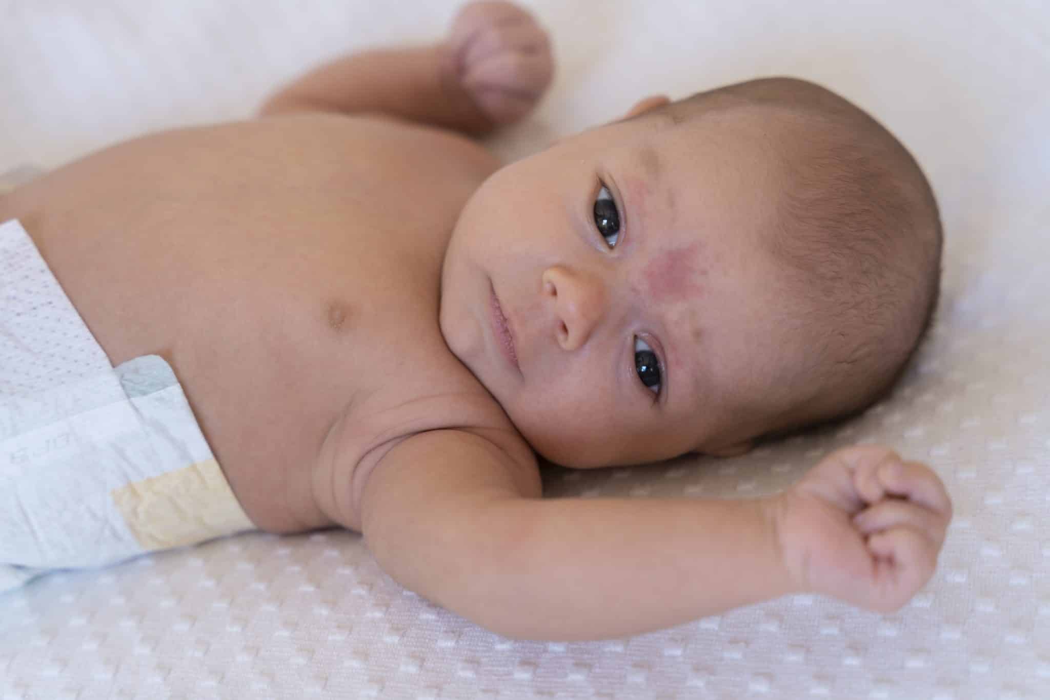 infant eczema treatment, Atopic Eczema Treatment Creams for Babies, Eczema in Small Babies, dermatitis in infants, infant eczema cream