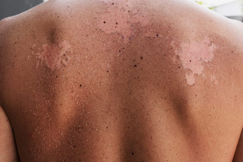 The Best Lotion for Sun Damaged Skin