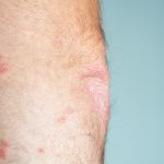 how to treat atopic dermatitis,